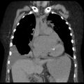 Cardiogenic pulmonary edema (Radiopaedia 29213-29609 Coronal non-contrast 17).jpg