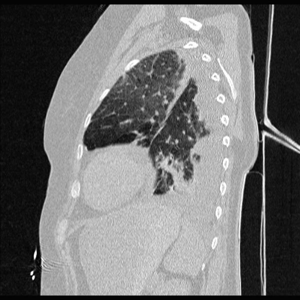 File:Cardiogenic pulmonary edema (Radiopaedia 29213-29609 Sagittal lung window 74).jpg