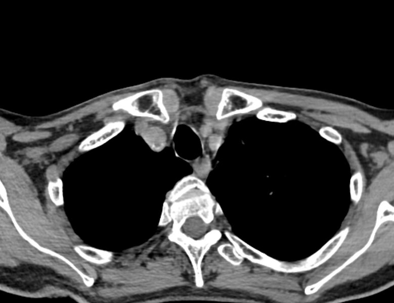 File:Carotid artery pseudoaneurysm (Radiopaedia 84030-99259 Axial non-contrast 54).jpg