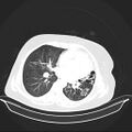 Carotid body tumor (Radiopaedia 21021-20948 Axial lung window 23).jpg