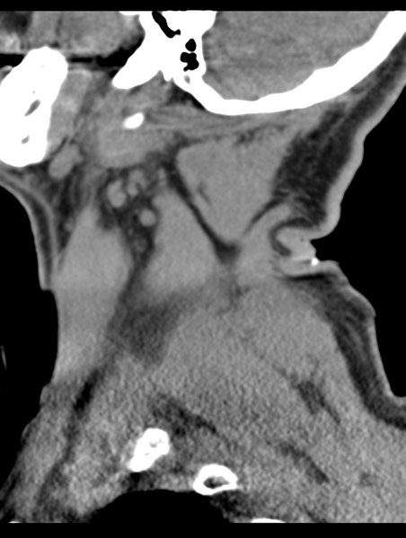 File:Cavernoma of cervical cord (Radiopaedia 50838-56346 B 11).png