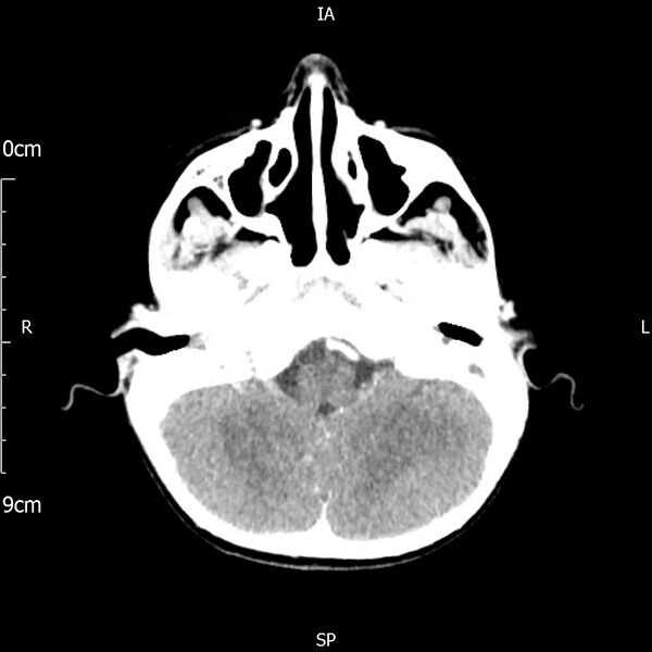 File:Cavernous sinus thrombosis (Radiopaedia 79414-92510 Axial Brain 61).jpg