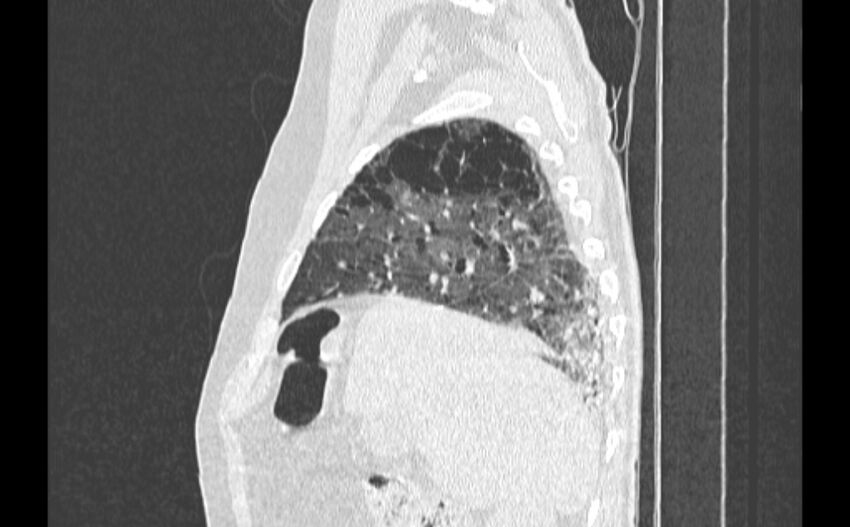 Cavitating bronchogenic carcinoma (Radiopaedia 44489-48162 Sagittal lung window 9).jpg