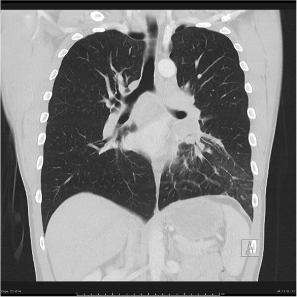File:Cavitating lung cancer (Radiopaedia 25796-25945 lung window 23).jpg