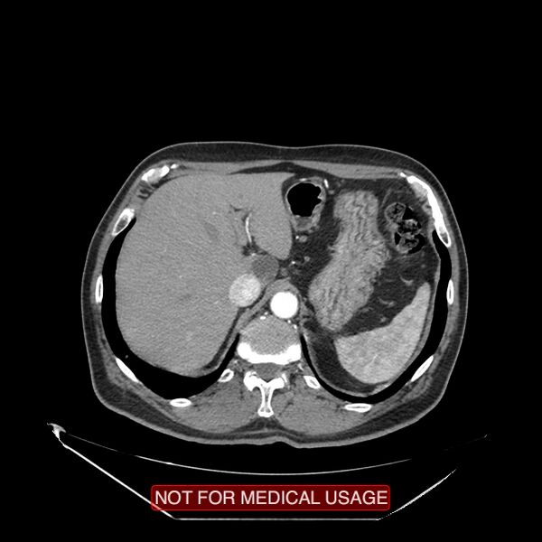 File:Celiac trunk variant anatomy - gastrohepatic trunk and splenic artery (Radiopaedia 38815-40995 A 1).jpg