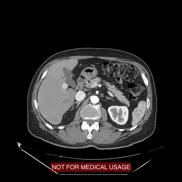 File:Celiac trunk variant anatomy - gastrohepatic trunk and splenic artery (Radiopaedia 38815-40995 A 33).jpg