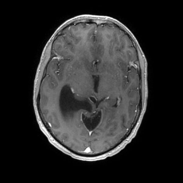 File:Central neurocytoma (Radiopaedia 67618-77021 Axial T1 C+ 12).jpg