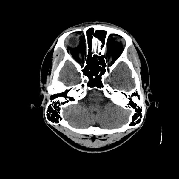 File:Central neurocytoma (Radiopaedia 79320-92379 Axial non-contrast 10).jpg