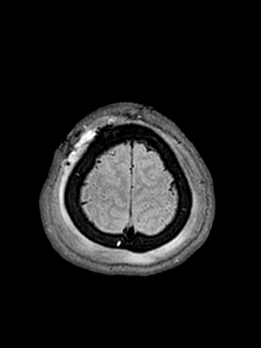 Central neurocytoma (Radiopaedia 79320-92381 Axial FLAIR 32).jpg
