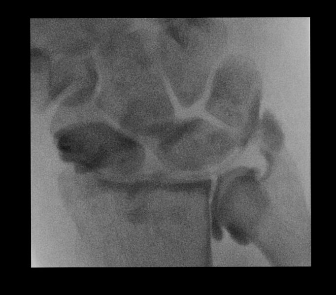 File:Central triangular fibrocartilage perforation (Radiopaedia 73346-84096 B 1).jpg