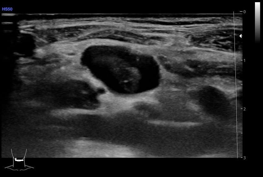Central venous catheter-related thrombosis (Radiopaedia 61135-69025 Transverse 27).jpg