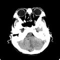 Cerebellar abscess secondary to mastoiditis (Radiopaedia 26284-26412 Axial non-contrast 31).jpg