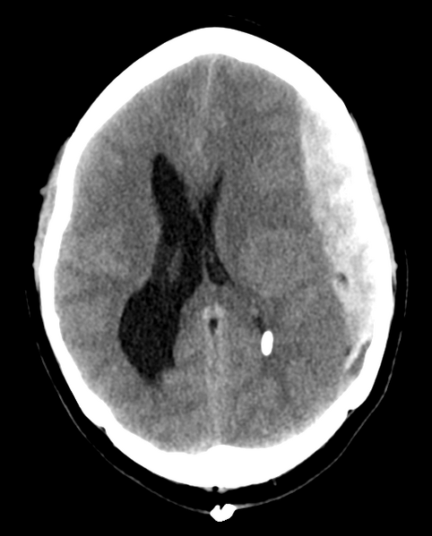 File:Cerebellar ependymoma complicated by post-operative subdural hematoma (Radiopaedia 83322-97737 Axial non-contrast 14).png