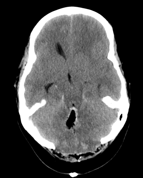 File:Cerebellar ependymoma complicated by post-operative subdural hematoma (Radiopaedia 83322-97737 Axial non-contrast 20).png