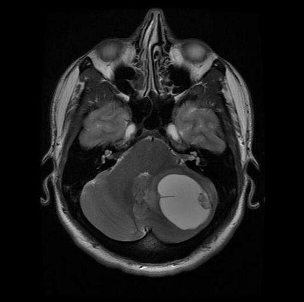 File:Cerebellar hemangioblastoma (Radiopaedia 11472-11835 A 1).jpg