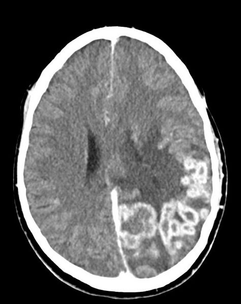File:Cerebral abscesses (Radiopaedia 70458-80568 Axial Contrast 39).jpg