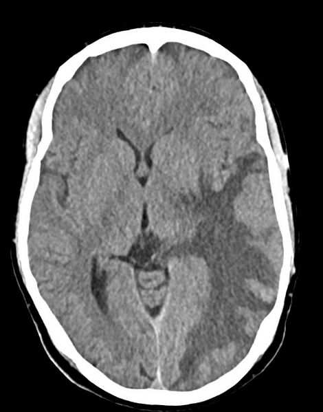 File:Cerebral abscesses (Radiopaedia 70458-80568 Axial non-contrast 31).jpg