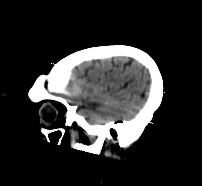 File:Cerebral amyloid angiopathy-associated lobar intracerebral hemorrhage (Radiopaedia 58377-65514 B 42).jpg