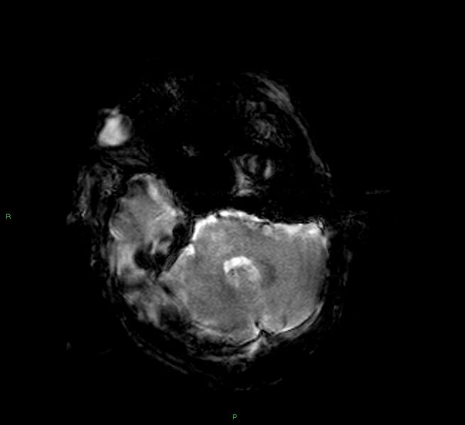 File:Cerebral amyloid angiopathy-associated lobar intracerebral hemorrhage (Radiopaedia 58377-65515 Axial Gradient Echo 19).jpg