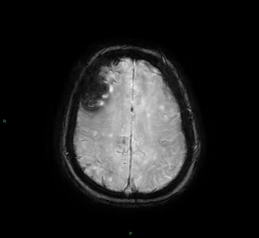 Cerebral amyloid angiopathy-associated lobar intracerebral hemorrhage (Radiopaedia 58378-65517 Axial SWI 56).jpg