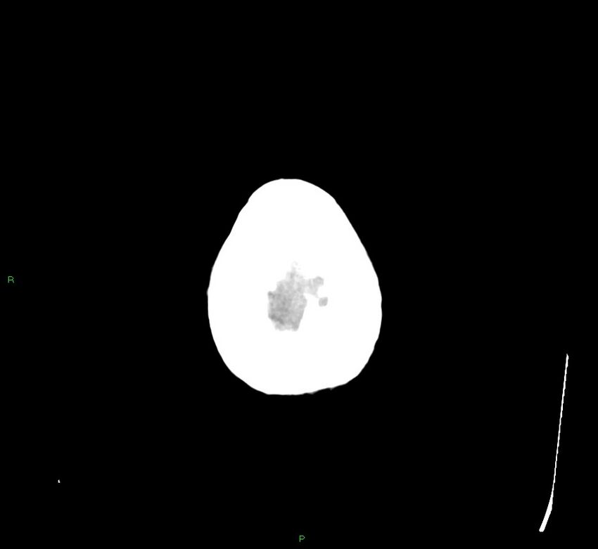 Cerebral amyloid angiopathy-associated lobar intracerebral hemorrhage (Radiopaedia 58529-65681 Axial non-contrast 4).jpg