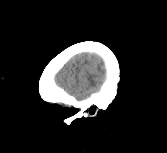 File:Cerebral amyloid angiopathy-associated lobar intracerebral hemorrhage (Radiopaedia 58563-65727 C 9).jpg