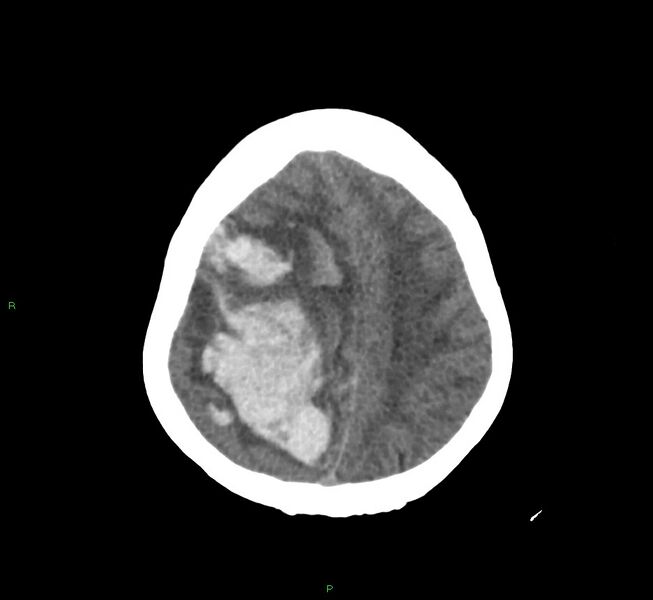 File:Cerebral amyloid angiopathy-associated lobar intracerebral hemorrhage (Radiopaedia 58751-65972 Axial non-contrast 15).jpg