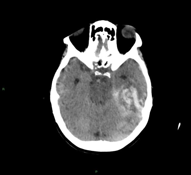 File:Cerebral amyloid angiopathy-associated lobar intracerebral hemorrhage (Radiopaedia 58754-65975 Axial non-contrast 41).jpg