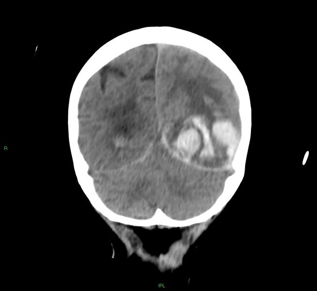 File:Cerebral amyloid angiopathy-associated lobar intracerebral hemorrhage (Radiopaedia 58754-65975 Coronal non-contrast 19).jpg