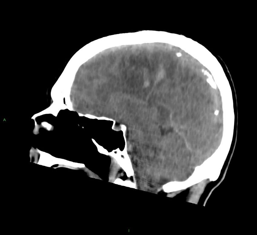 Cerebral amyloid angiopathy-associated lobar intracerebral hemorrhage (Radiopaedia 58756-65977 C 29).jpg