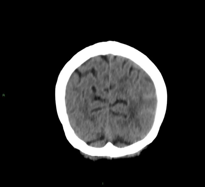 File:Cerebral amyloid angiopathy-associated lobar intracerebral hemorrhage (Radiopaedia 58757-65978 Coronal non-contrast 15).jpg