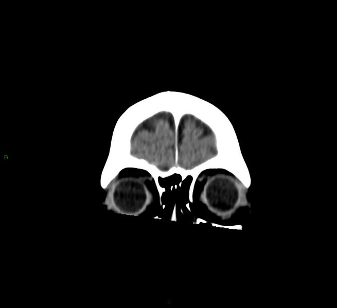 File:Cerebral amyloid angiopathy-associated lobar intracerebral hemorrhage (Radiopaedia 58757-65978 Coronal non-contrast 59).jpg