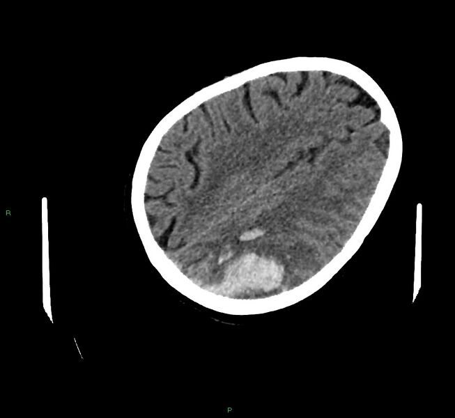 File:Cerebral amyloid angiopathy-associated lobar intracerebral hemorrhage (Radiopaedia 58757-65979 Axial non-contrast 97).jpg