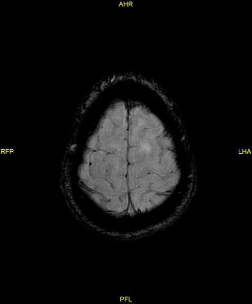 File:Cerebral autosomal dominant arteriopathy with subcortical infarcts and leukoencephalopathy (CADASIL) (Radiopaedia 86108-102054 Axial SWI 94).jpg