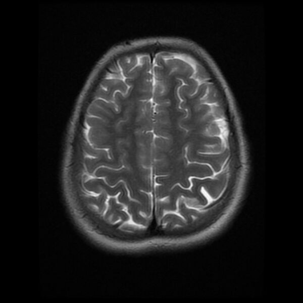 File:Cerebral cavernous malformation (Radiopaedia 44301-47942 Axial T2 17).jpg