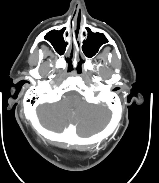 File:Cerebral dural venous sinus thrombosis (Radiopaedia 86514-102576 A 29).jpg