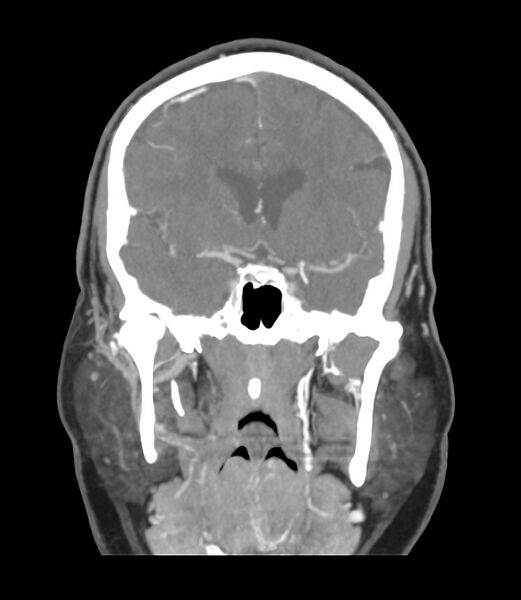 File:Cerebral dural venous sinus thrombosis (Radiopaedia 86514-102576 B 27).jpg