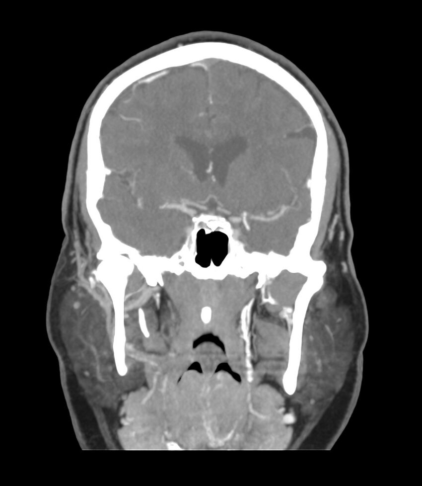 Cerebral dural venous sinus thrombosis (Radiopaedia 86514-102576 B 27).jpg