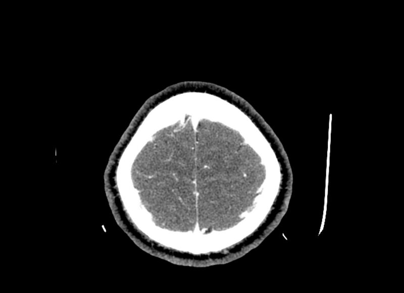 File:Cerebral edema (Radiopaedia 82519-96661 B 11).jpg