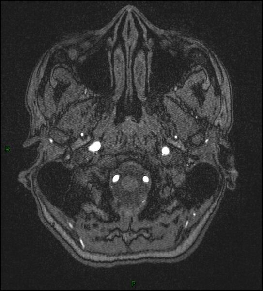 File:Cerebral fat embolism (Radiopaedia 35022-36525 Axial TOF 7).jpg