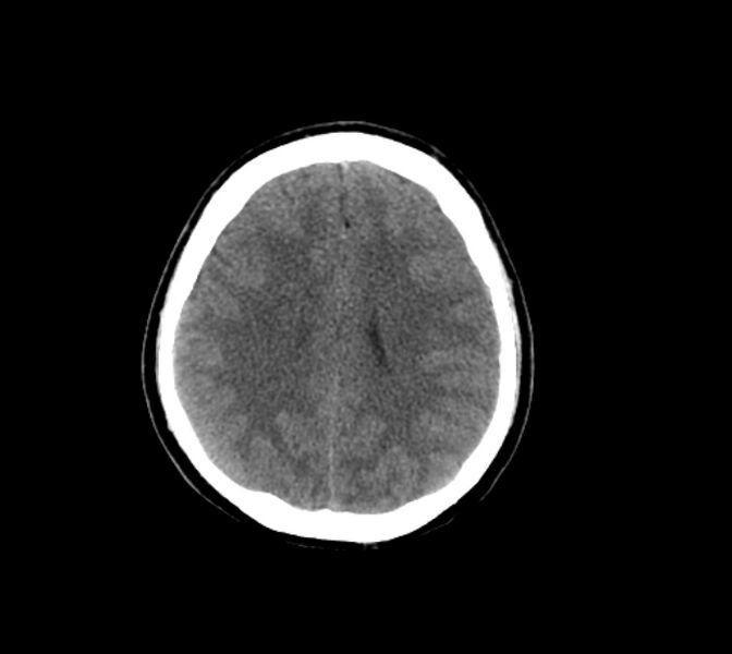 File:Cerebral fat embolism (Radiopaedia 37510-39362 Axial non-contrast 23).jpg