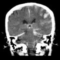 Cerebral hemorrhagic contusions (Radiopaedia 23145-23188 Coronal non-contrast 27).jpg