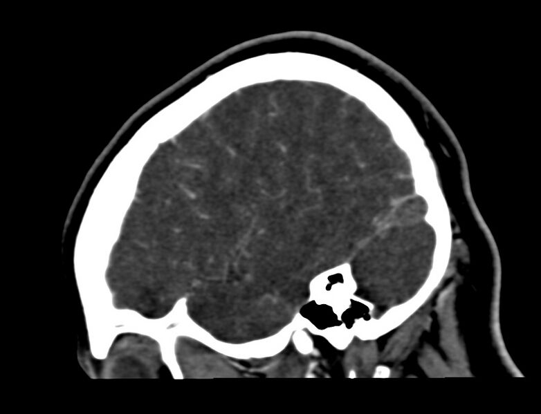 File:Cerebral venous sinus thrombosis (Radiopaedia 59224-66646 Sagittal C+ delayed 55).jpg