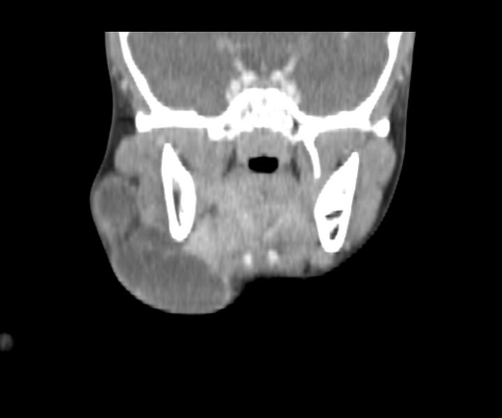 File:Cervical cystic lymphangioma (Radiopaedia 63655-72332 Coronal + contrast 17).jpg