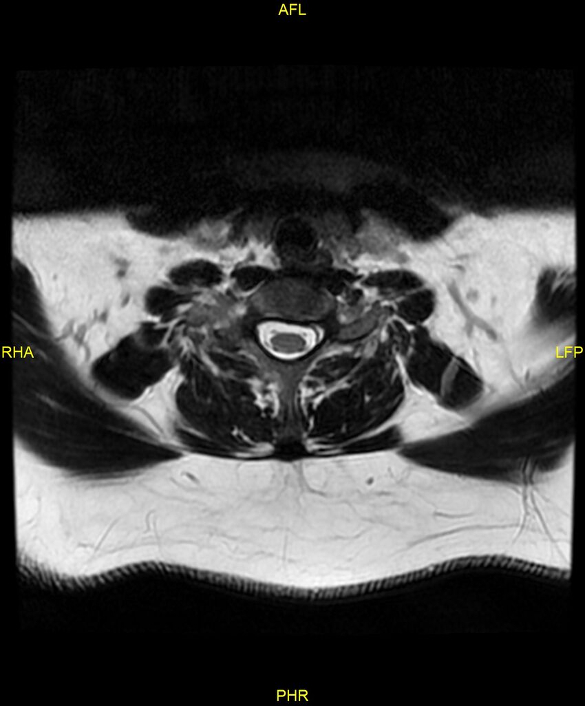 Cervical disc protrusion (Radiopaedia 87147-103415 Axial T2 56).jpg