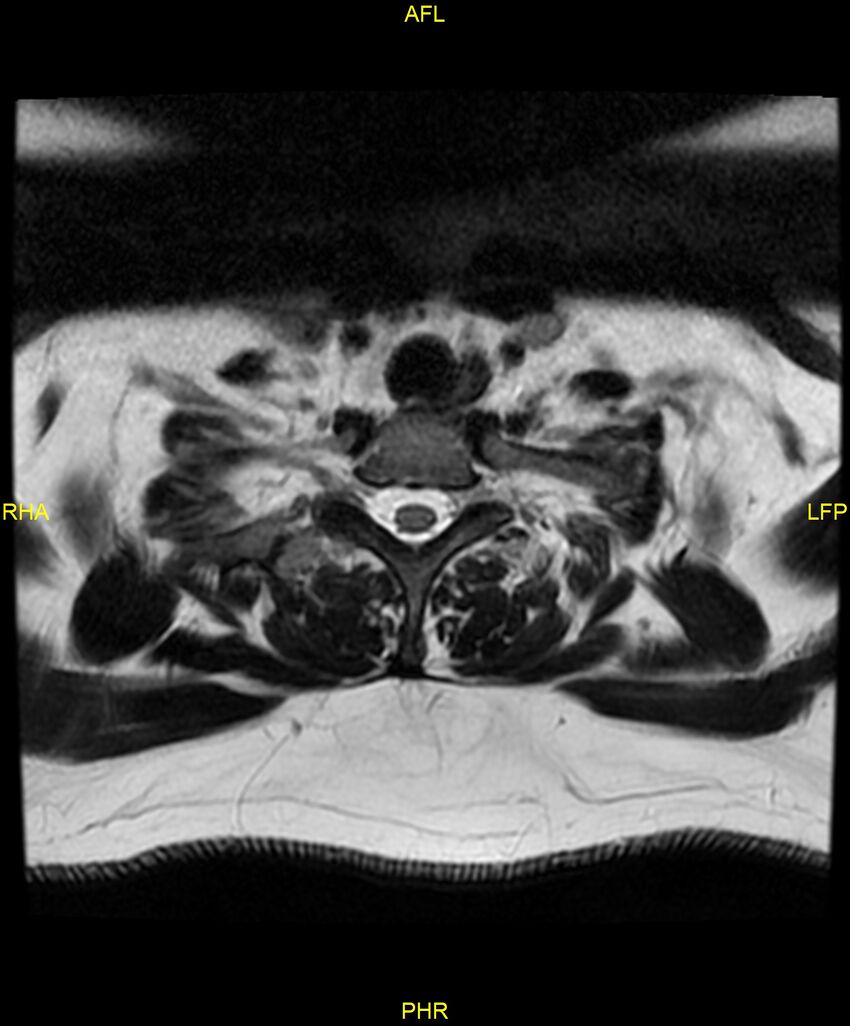 Cervical disc protrusion (Radiopaedia 87147-103415 Axial T2 77).jpg