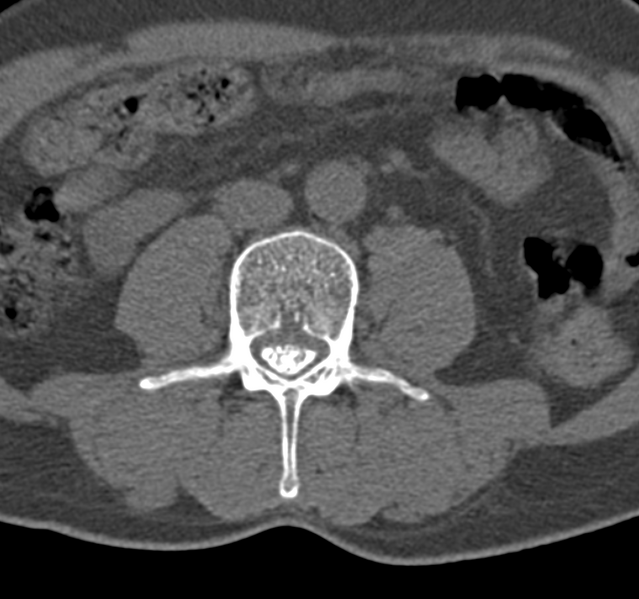 File:Cervical dural CSF leak on MRI and CT treated by blood patch (Radiopaedia 49748-54996 B 103).png
