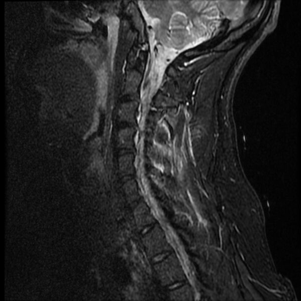 File:Cervical facet fracture and anterior discoligamentous injury (Radiopaedia 32139-33084 Sagittal STIR 11).jpg