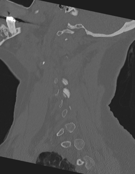 File:Cervical spine ACDF loosening (Radiopaedia 48998-54071 Sagittal bone window 26).png