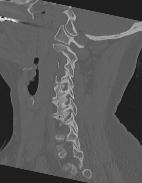 File:Cervical spine ACDF loosening (Radiopaedia 48998-54071 Sagittal bone window 33).png